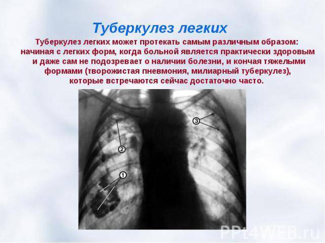 Туберкулез у детей. информация для родителей - доказательная медицина для всех