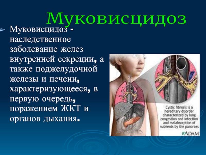 Муковисцидоз: симптомы и лечение, диагностика - сибирский медицинский портал