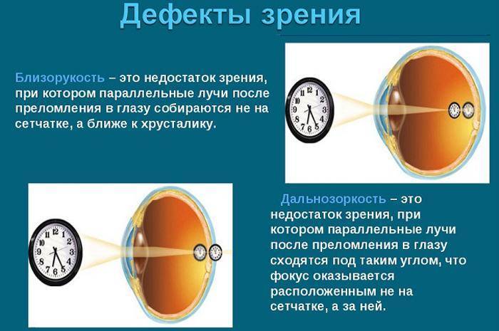 Смешанный астигматизм обоих глаз, лечение и коррекция смешанного астигматизма в клинике fedorovmedcenter.ru