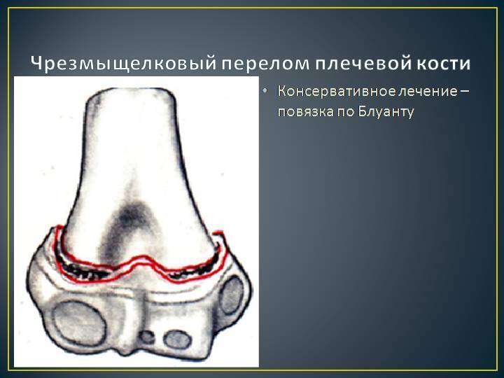 Переломы мыщелка плеча - симптомы болезни, профилактика и лечение переломов мыщелка плеча, причины заболевания и его диагностика на eurolab