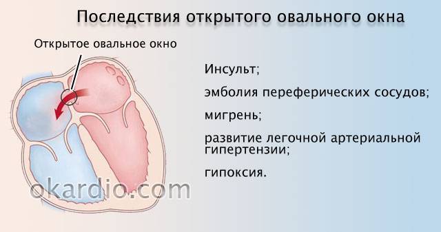 Открытый артериальный проток - лечение в отделении института амосова.