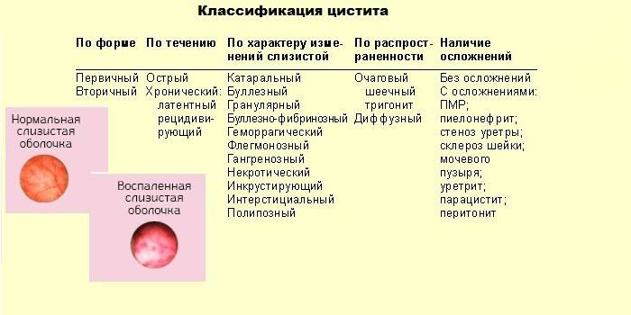 Цистит у мужчин | симптомы | диагностика | лечение - docdoc.ru
