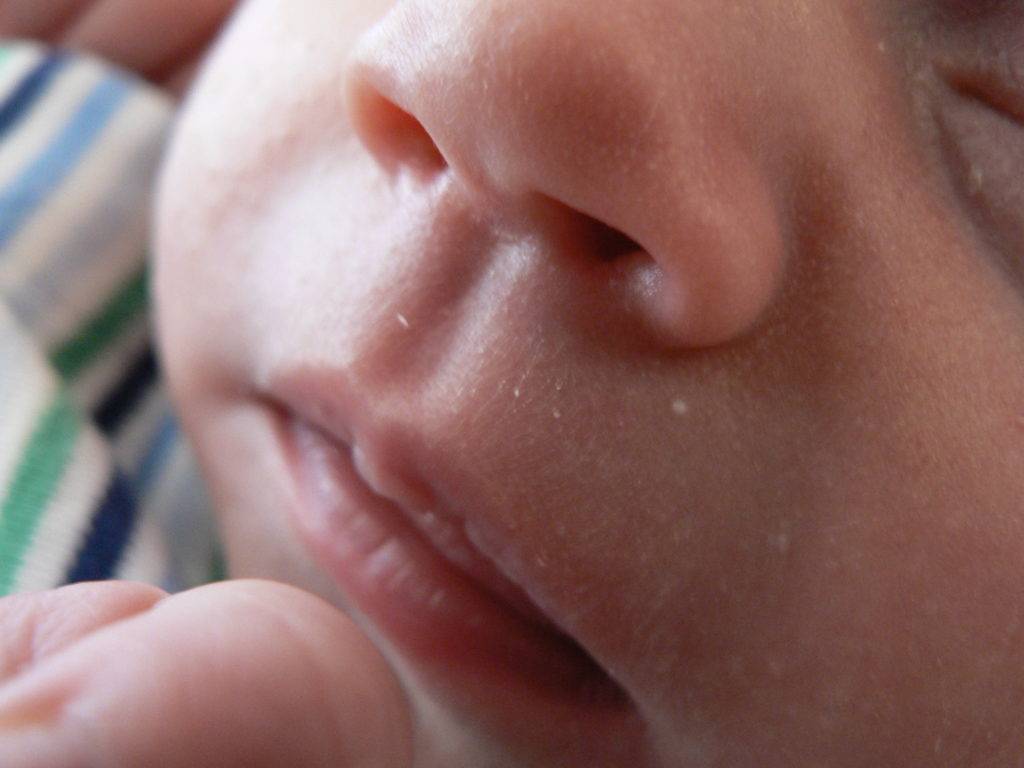 Кандидоз полости рта: симптомы и лечение