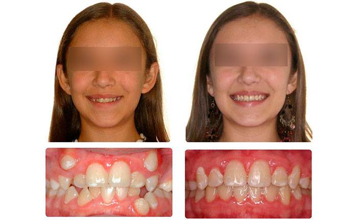 Установка брекетов детям: цены в стоматологической клинике доктор мартин в москве