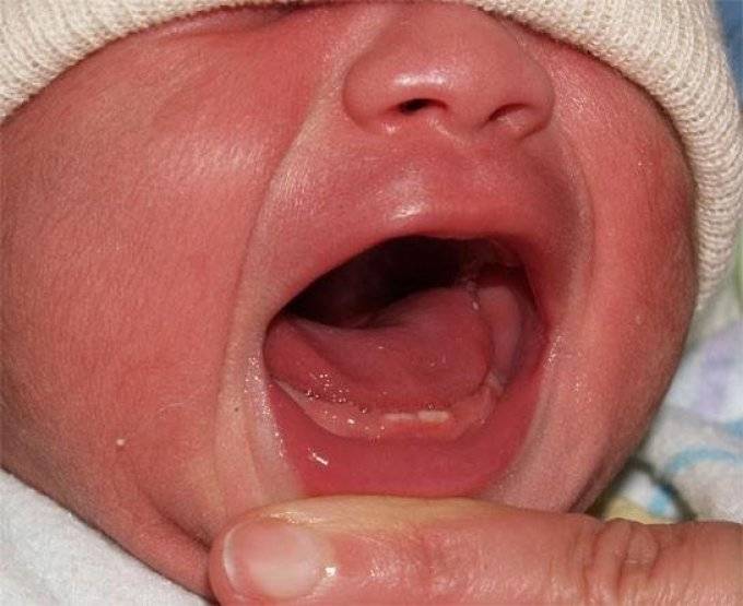 Кашель при прорезывании зубов у ребенка - может ли быть и почему