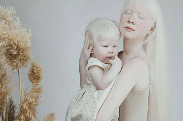 Альбинизм, причины болезни и ее лечение