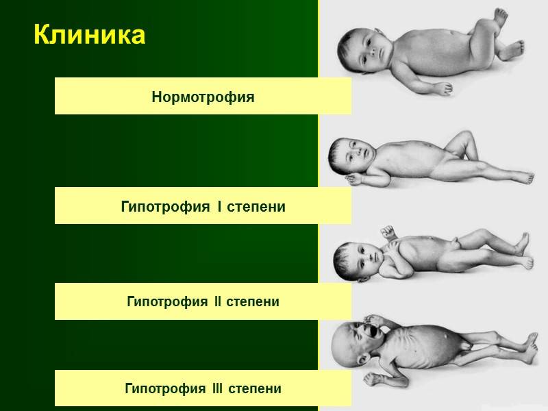 Гипотрофия у детей раннего возраста: 1, 2 и 3 степени (лечение, профилактика)