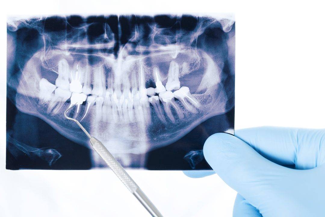 Можно ли делать рентген зубов ребёнку?