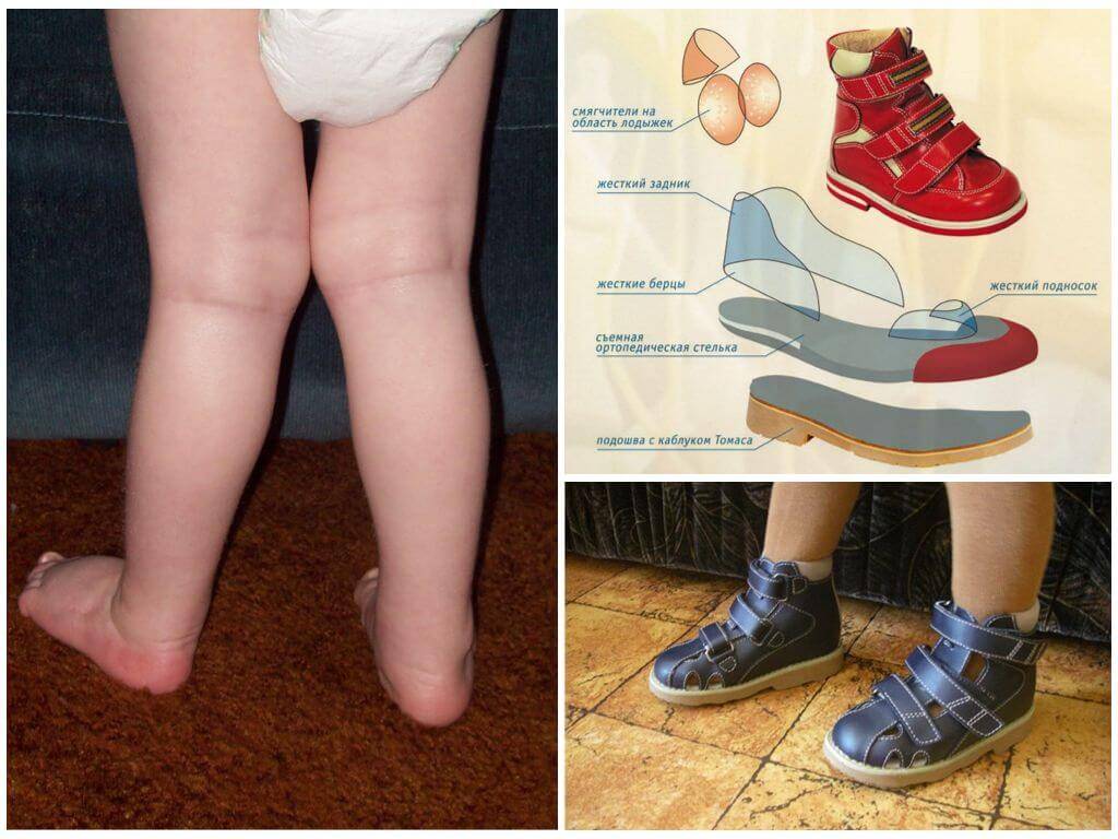 Вальгусная деформация стопы у детей (плосковальгусная) с фото: способы лечения искривления