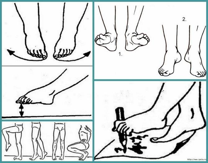Массаж и гимнастика при вальгусной и плосковальгусной деформации стопы у детей: видео-урок с упражнениями
