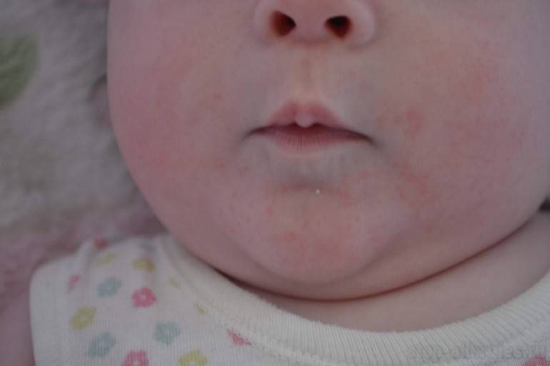 Аллергия на гречку: причины, симптомы, лечение | компетентно о здоровье на ilive