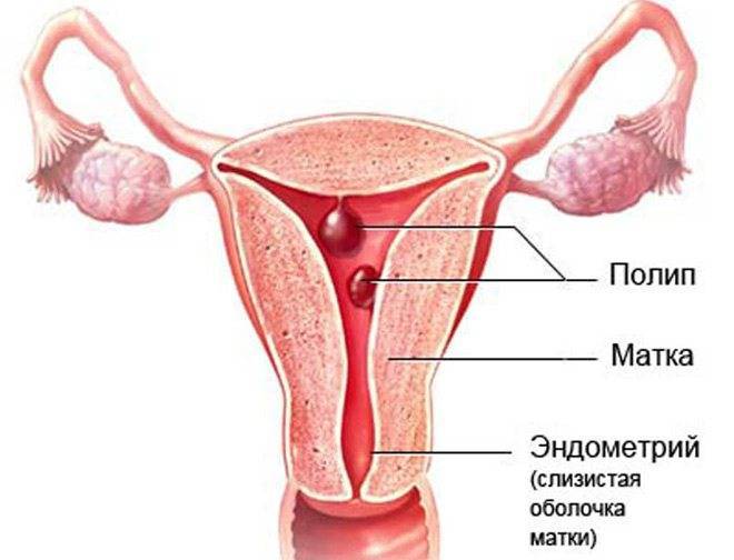 Гиперплазия эндометрия и беременность: можно ли забеременеть при этой патологии матки?