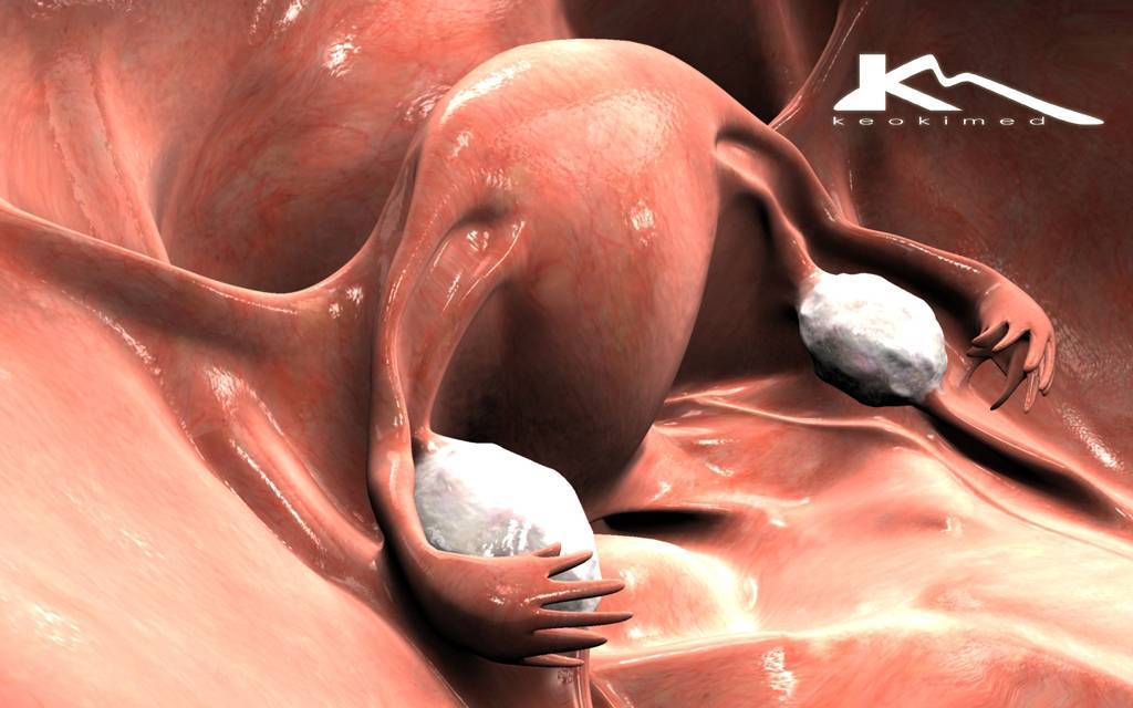 Беременность с одним яичником: можно ли женщина забеременеть и родить