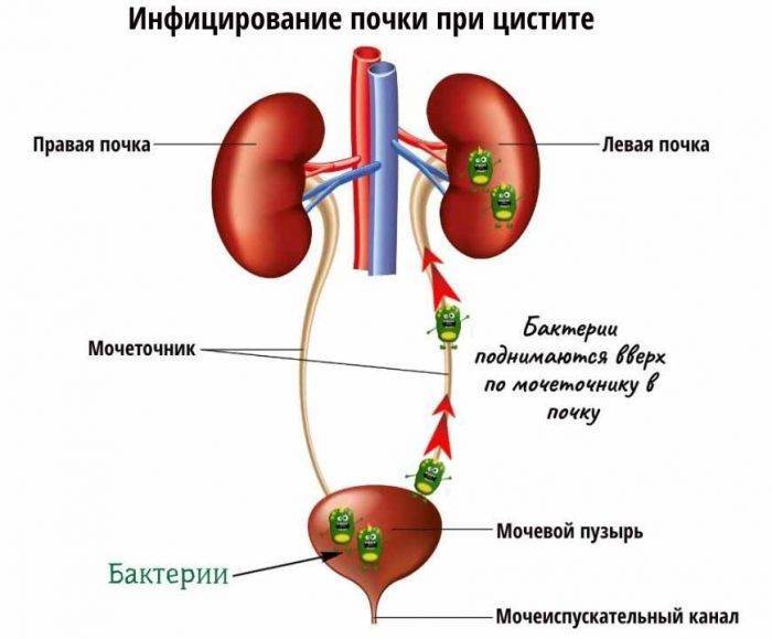 Воспаление почек у детей: симптомы и лечение, заболевания мочевыводящих путей
