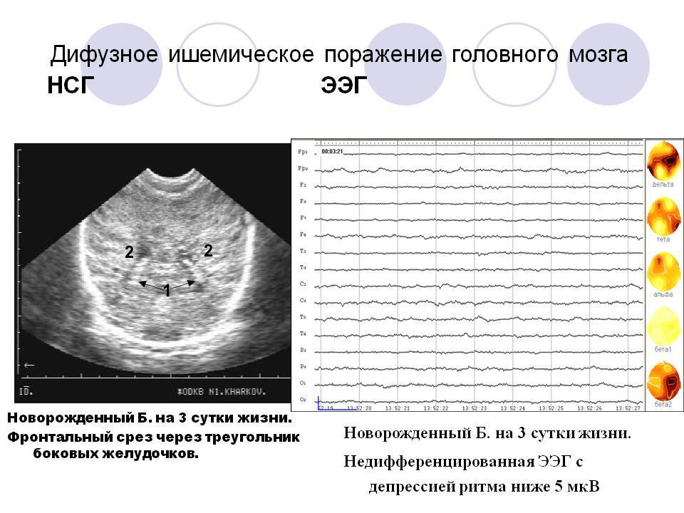 Ишемическая головного мозга новорожденного. УЗИ головного мозга нейросонография. УЗИ анатомия НСГ. Ультразвуковая анатомия головного мозга новорожденных. Анатомия головного мозга новорожденного на УЗИ.