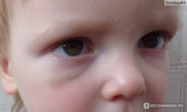 Причины появления синяков под глазами у малыша: от чего у ребенка синева в подглазинах