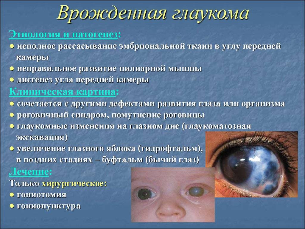 Причины детской гиперметропии