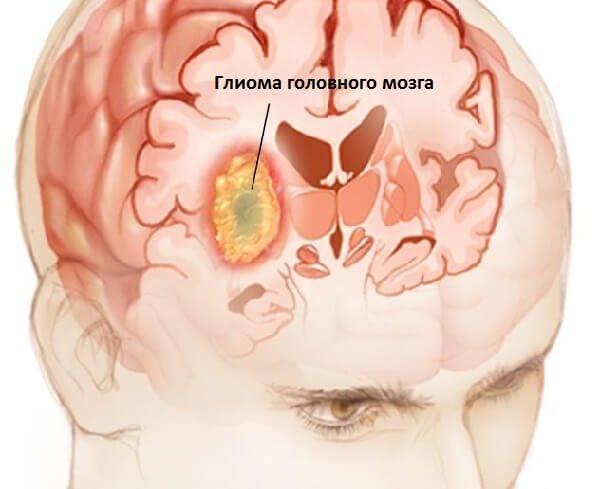 Обзор онкологических заболеваний менингиомы
