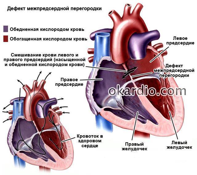 Пороки сердца у детей: аневризма межпредсердной перегородки — медицинский центр в махачкале «целитель»