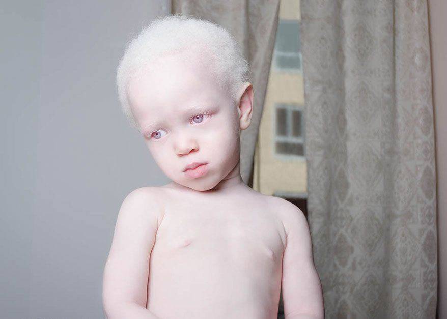 Альбинизм | компетентно о здоровье на ilive