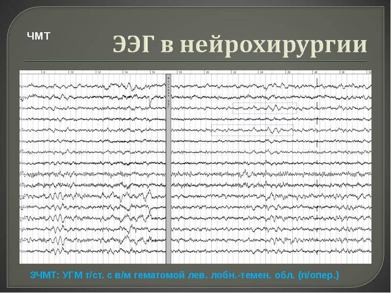 Электроэнцефалография (ээг) – запись на исследование в москве