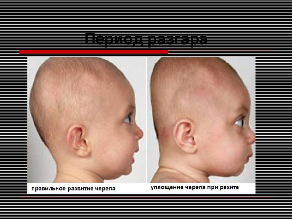 Асимметрия лица у ребенка - когда следует обратиться к врачу - beautyvertebro.com
