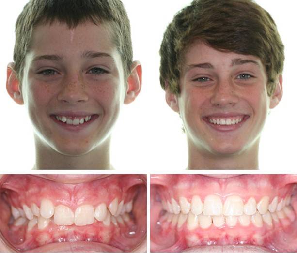 Как выровнять зубы взрослому