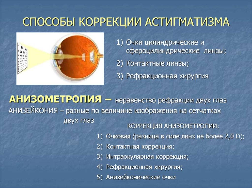 Астигматизм: причины и лечение. коррекция астигматизма