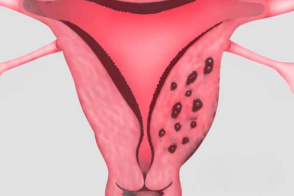 Лечение эндометриоза у женщин после 40-50 лет во время менопаузы