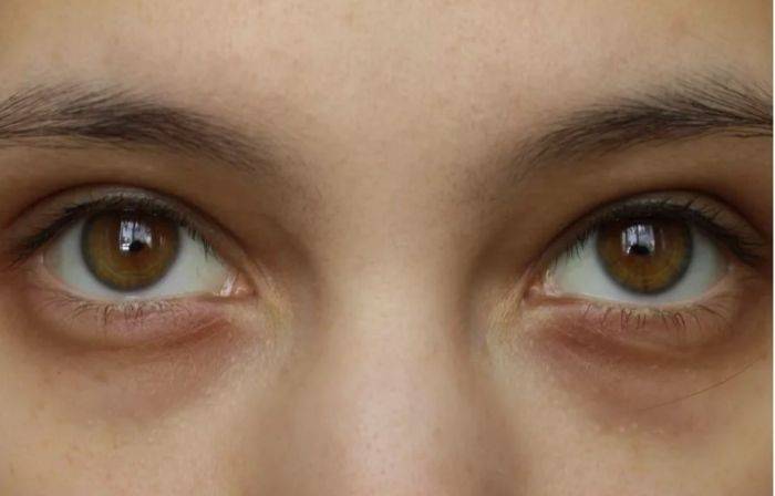 Причины появления у грудничков темных, синих, коричневых синяков вокруг глаз