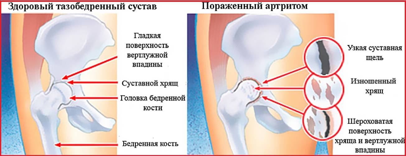 Синовит и теносиновит – воспаление суставов - нолтрекс.