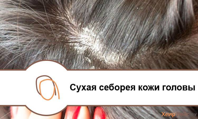 У ребенка перхоть и шелушение кожи головы: причины и лечение шампунями