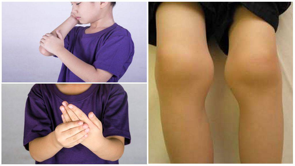 Ревматоидный артрит у детей