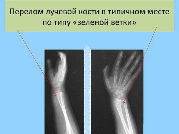 Перелом дистального метаэпифиза лучевой кости (перелом лучевой кости «в типичном месте») — симптомы, диагностика, лечение в цкб ран