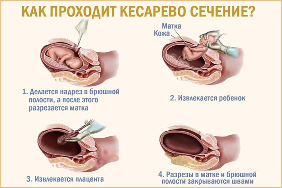 Начало родов после снятия акушерского пессария