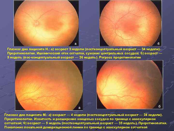 Диабетическая ретинопатия, ее симптоматика и стадии развития