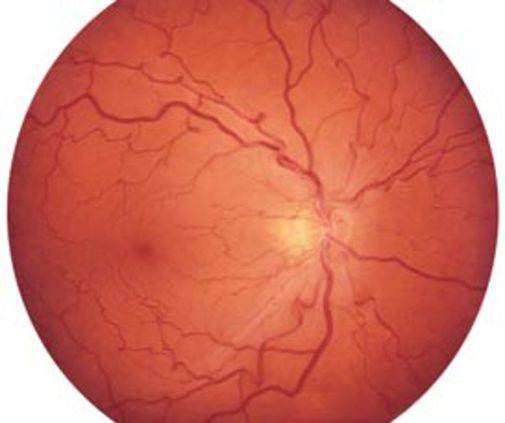 Фоновая (вторичная) ретинопатия