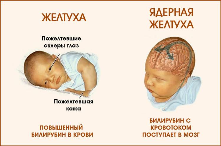 Желтуха у новорожденных: причины, последствия и лечение (физиологическая, неонатальная, ядерная)