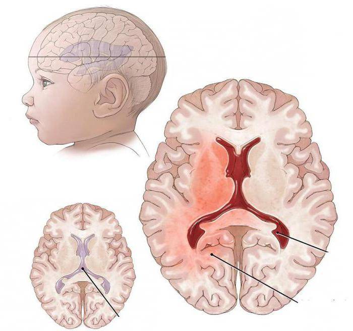 Ишемия головного мозга у новорожденного - последствия и лечение поражения у детей