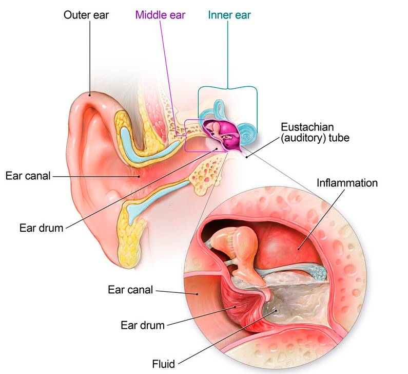 Острый отит, фото, причины и лечение острого отита среднего уха без температуры, причины и последствия боли