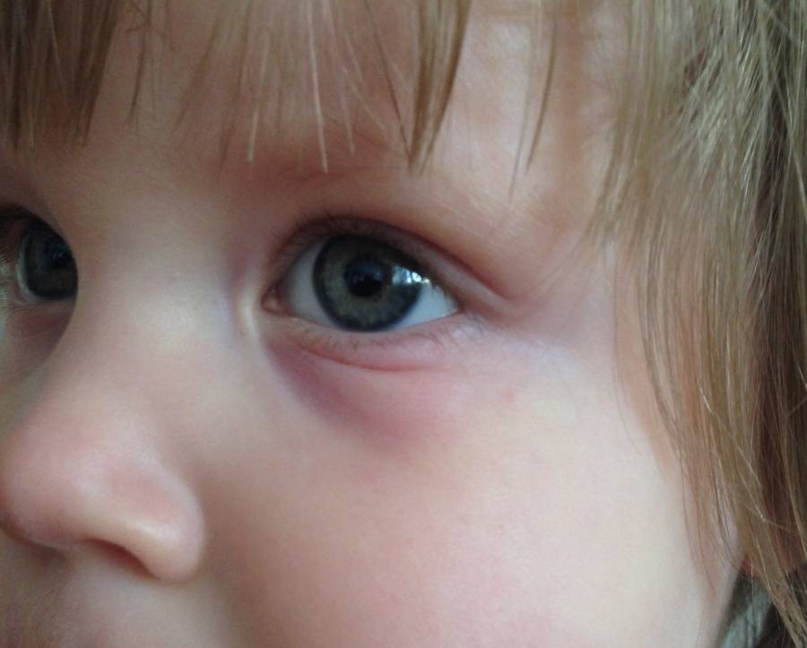 Синяки и круги под глазами у новорожденного ребенка до года