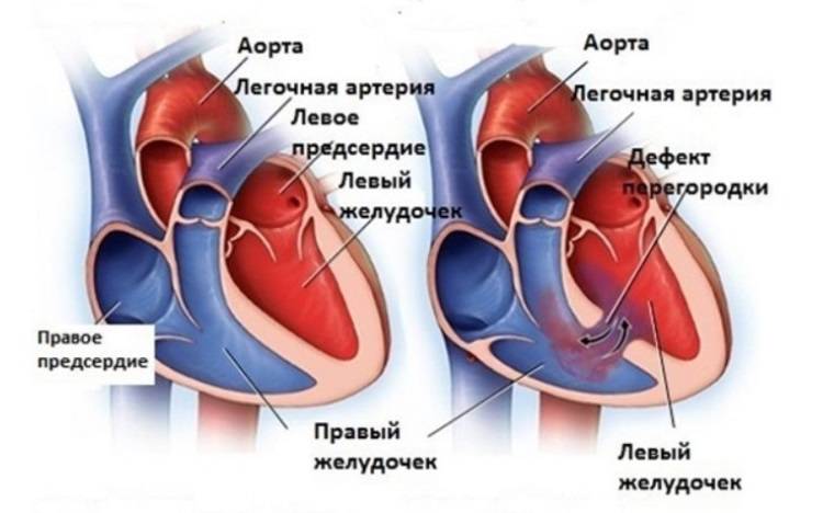 Пороки сердца врожденные и приобретенные: диагностика и лечение