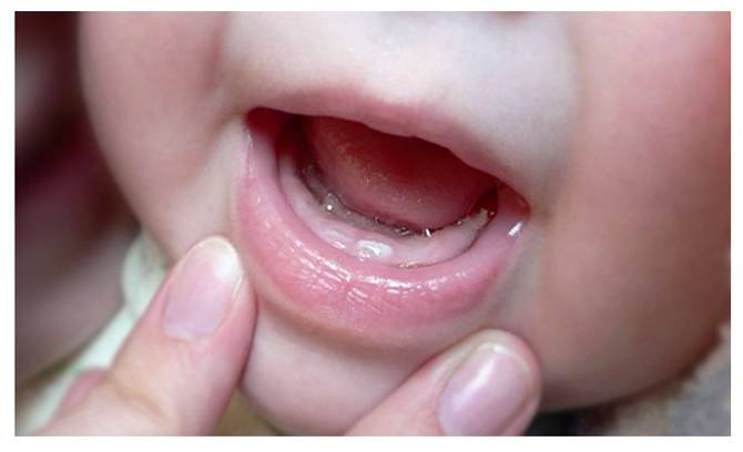 Как отличить простуду от прорезывания зубов, советы родителям