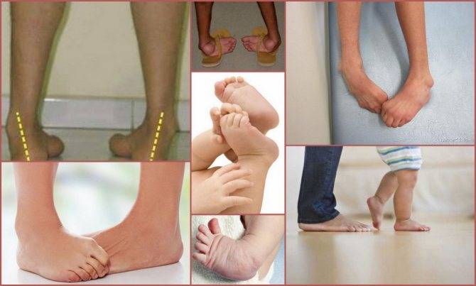 Вальгусная деформация первого пальца стопы – лечение