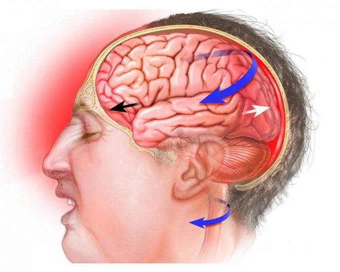 Черепно-мозговая травма у взрослых и детей. что нужно знать