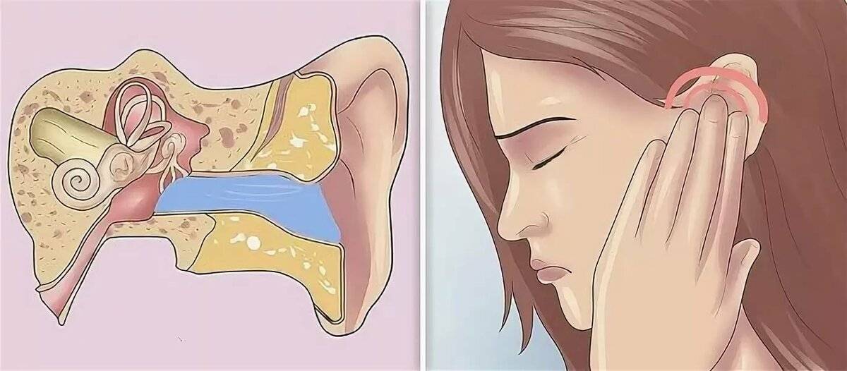 Шум в ушах (шум в голове) или тиннитус: причины и лечение – напоправку