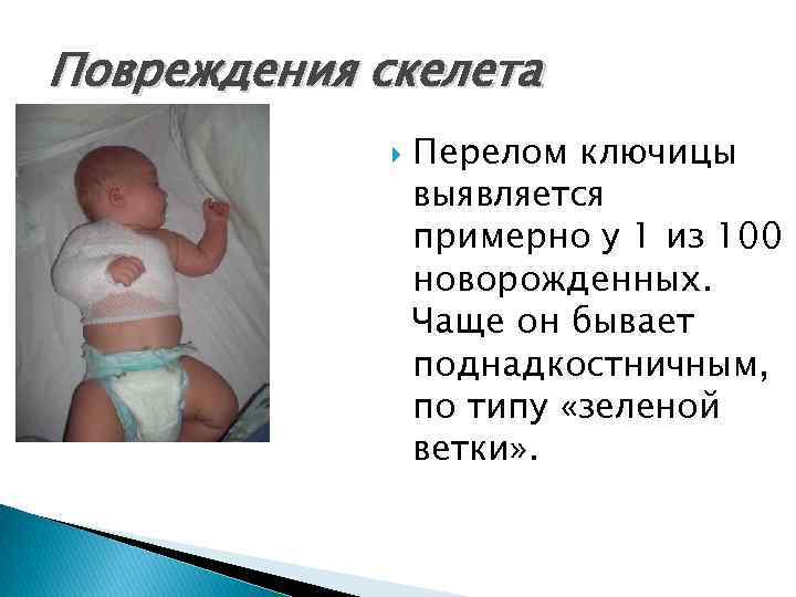 Перелом ключицы у новорожденного при родах: последствия для ребенка