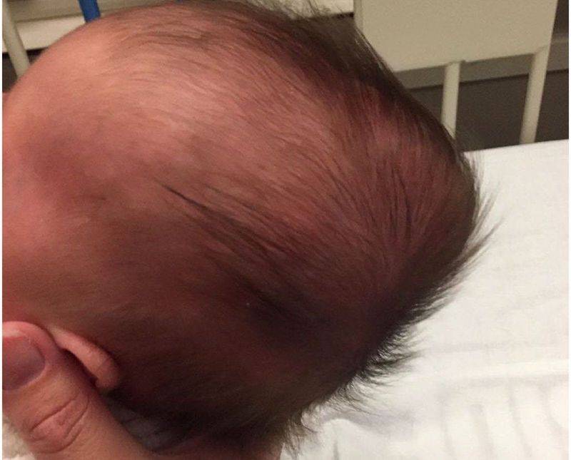 Деформация головы у новорожденного — что нужно знать родителям