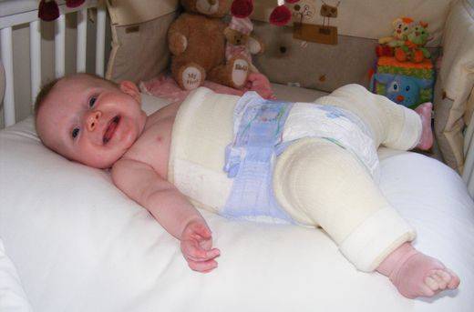 Дисплазия тазобедренных суставов у детей до года (новорожденных): лечение и признаки с фото