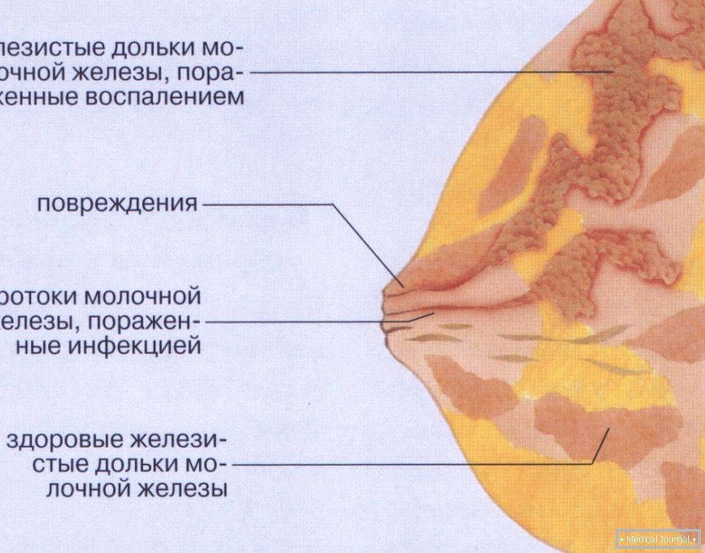Противопоказания к узи молочной железы